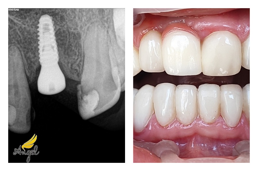 implant