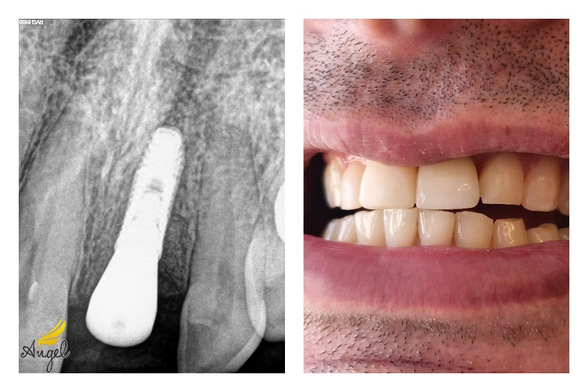 implant