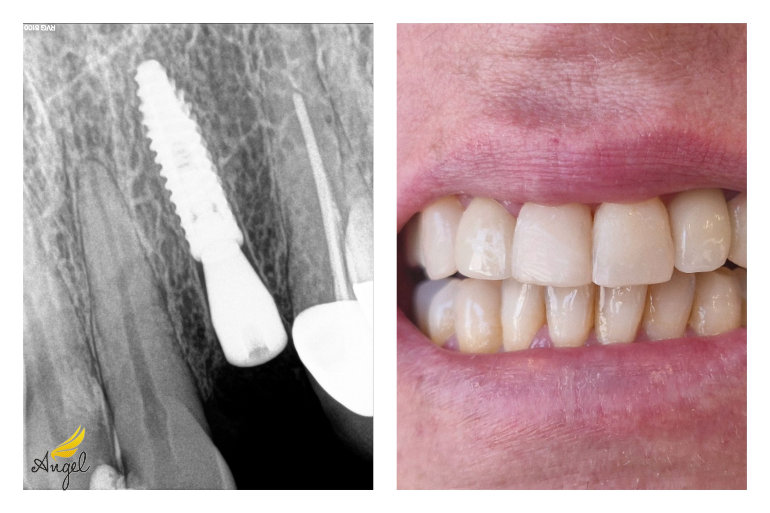 implant